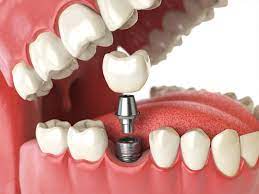 implants 